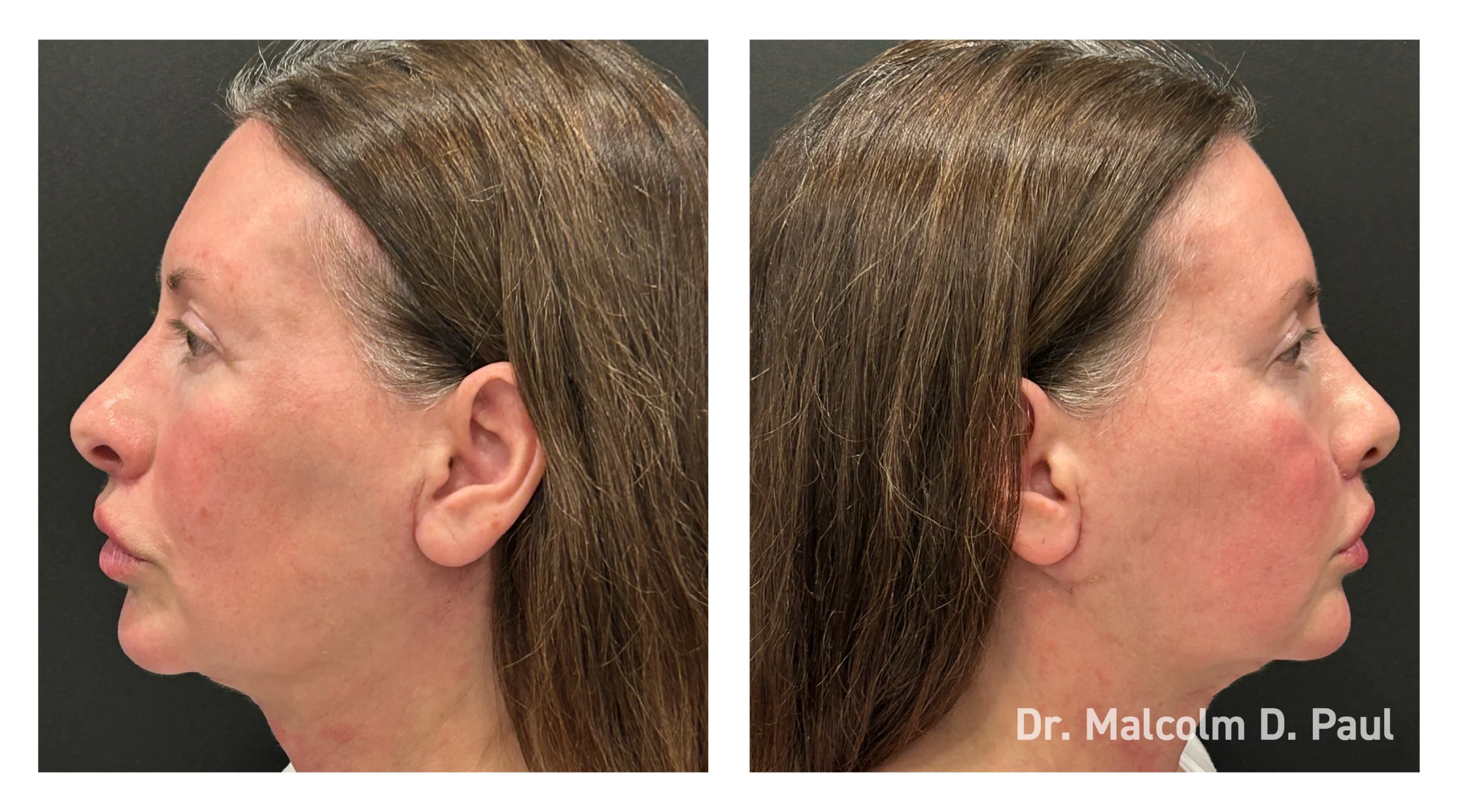 Before&After_03