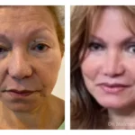 Blepharoplasties-+face+and+necklift-1920w