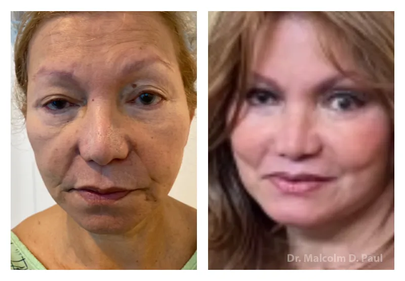 Blepharoplasties-+face+and+necklift-1920w