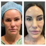 Minimal+Incision+Princess+Face+Lift-1920w