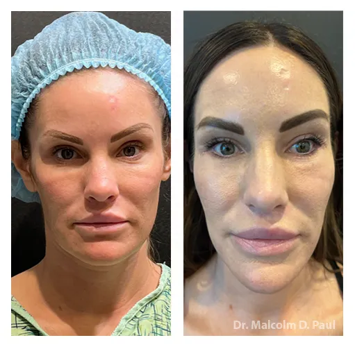 Minimal+Incision+Princess+Face+Lift-1920w