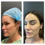 Minimal+Incision+Princess+Face+Lift2-1920w