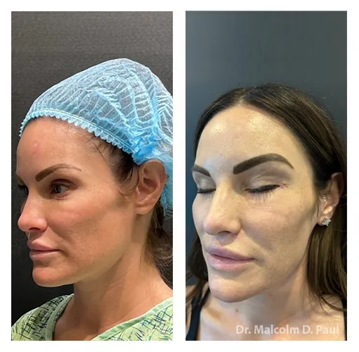 Minimal+Incision+Princess+Face+Lift2-1920w
