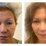 Pre+Op+Blepharoplasties+Face+and+Necklift-1920w