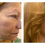 Pre+Op+Blepharoplasties+Face+and+Necklift2-1920w