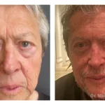 Pre+and+post+op+blepharoplasties-+face+and+neck+lift-+and+direct+excision+of+naso-labia+folds-1920w