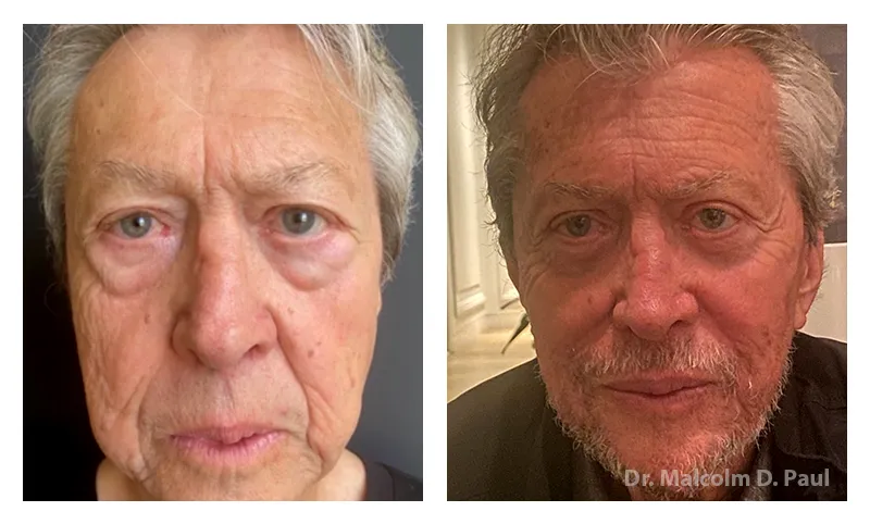 Pre+and+post+op+blepharoplasties-+face+and+neck+lift-+and+direct+excision+of+naso-labia+folds-1920w