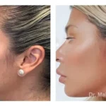Pre+and+post+op+buccal+fat+pad+removal+and+jawline+liposuction-1920w