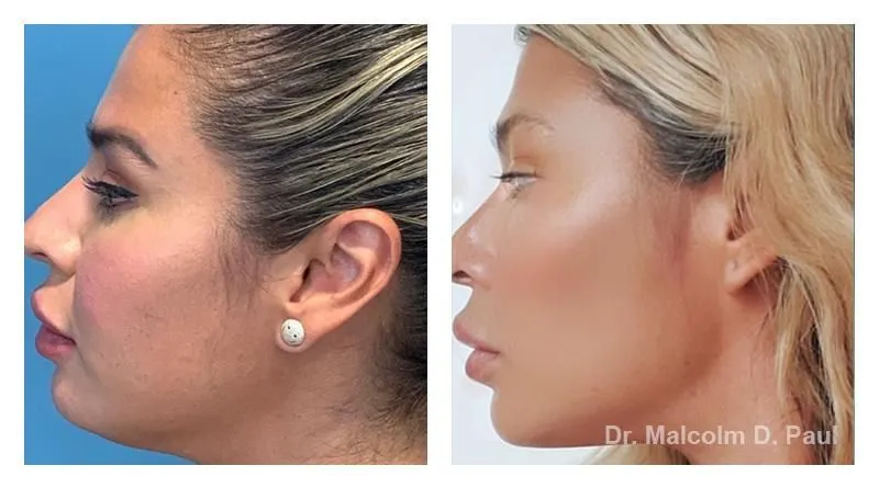 Pre+and+post+op+buccal+fat+pad+removal+and+jawline+liposuction-1920w