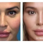 Pre+and+post+op+buccal+fat+pad+removal+and+jawline+liposuction2-1920w