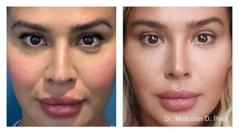Pre+and+post+op+buccal+fat+pad+removal+and+jawline+liposuction2-1920w