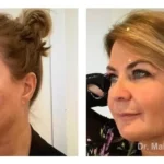 Pre+and+post+op+buccal+fat+pad+removal+and+jawline+liposuction3-1920w