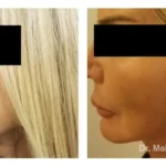 Pre+and+post+op+face+and+necklift-1920w (1)