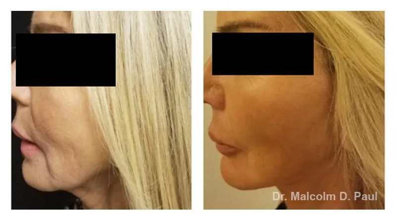 Pre+and+post+op+face+and+necklift-1920w (1)