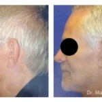 Pre+and+post+op+face+and+necklift-1920w