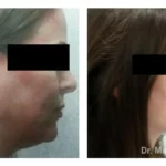 Pre+and+post+op+face+and+necklift-+and+temporal+brow+lift-1920w