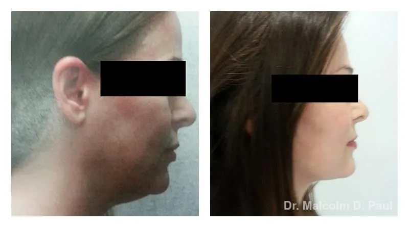 Pre+and+post+op+face+and+necklift-+and+temporal+brow+lift-1920w