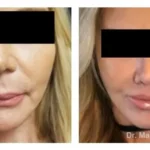 Pre+and+post+op+face+and+necklift-+and+upper+lip+lift-1920w