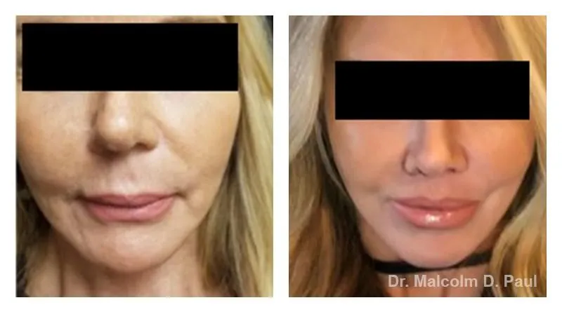 Pre+and+post+op+face+and+necklift-+and+upper+lip+lift-1920w
