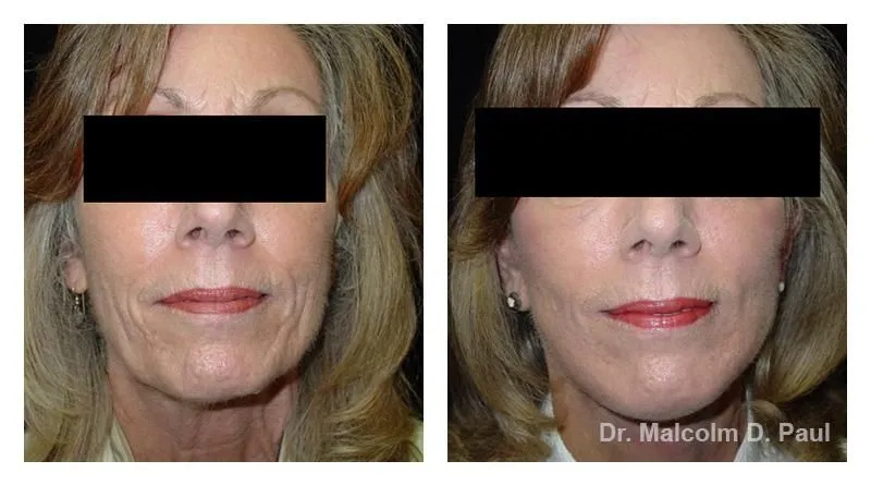 Pre+and+post+op+face+and+necklift10-1920w