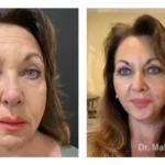 Pre+and+post+op+face+and+necklift11-1920w