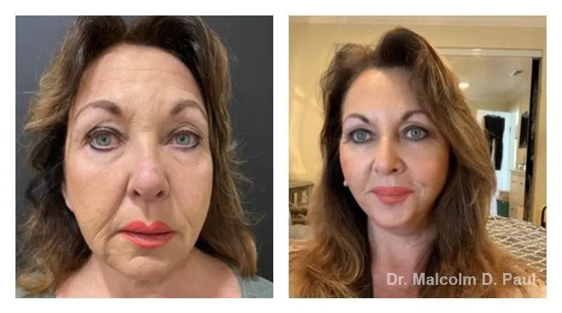 Pre+and+post+op+face+and+necklift11-1920w
