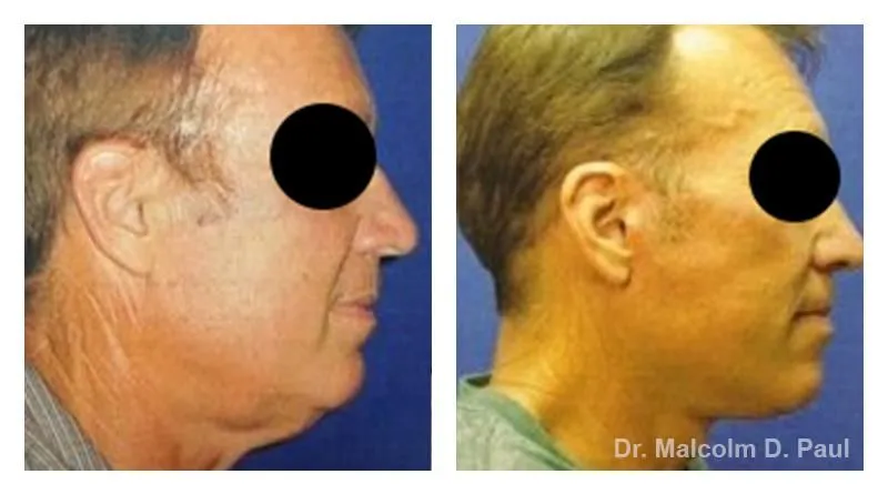 Pre+and+post+op+face+and+necklift2-1920w