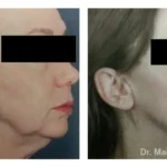 Pre+and+post+op+face+and+necklift3-1920w