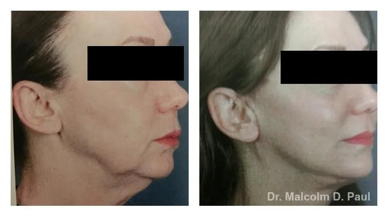 Pre+and+post+op+face+and+necklift3-1920w