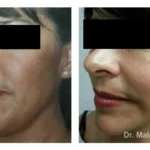 Pre+and+post+op+face+and+necklift4-1920w