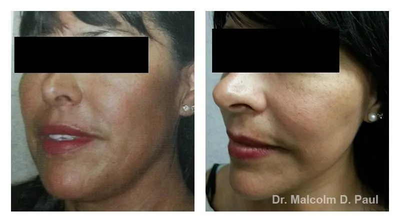 Pre+and+post+op+face+and+necklift4-1920w