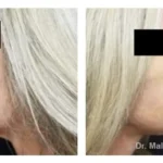 Pre+and+post+op+face+and+necklift5-1920w