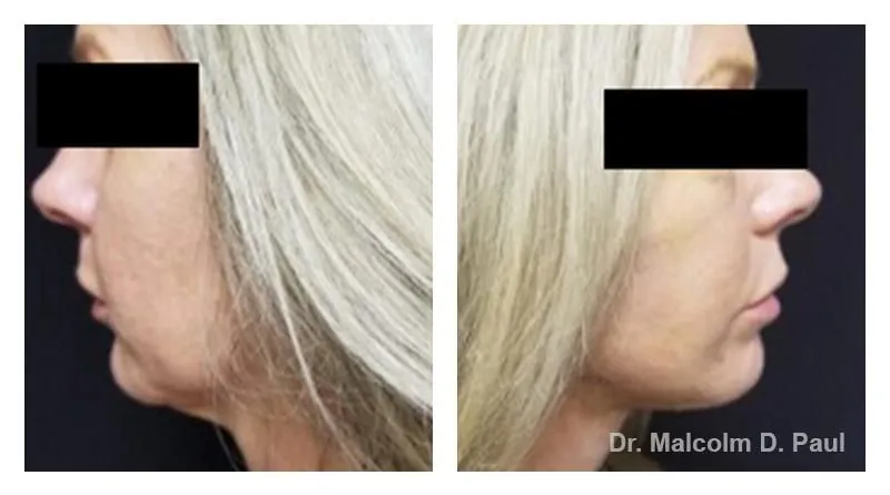 Pre+and+post+op+face+and+necklift5-1920w