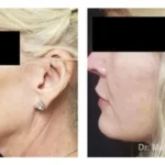 Pre+and+post+op+face+and+necklift+6-1920w