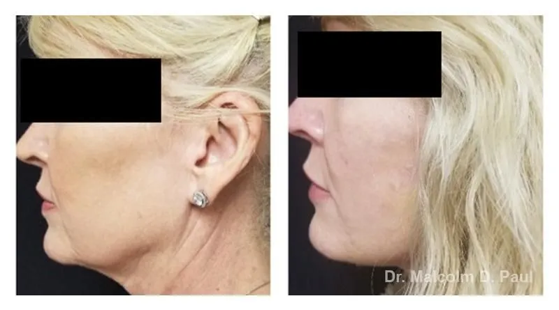 Pre+and+post+op+face+and+necklift+6-1920w