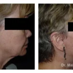Pre+and+post+op+face+and+necklift7-1920w