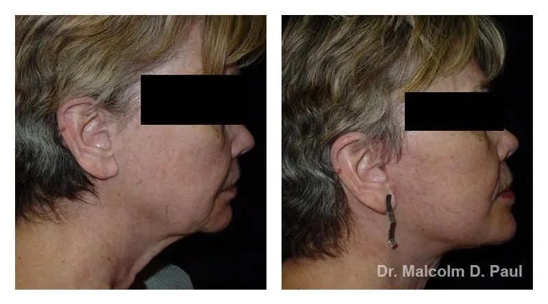 Pre+and+post+op+face+and+necklift7-1920w