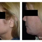 Pre+and+post+op+face+and+necklift8-1920w