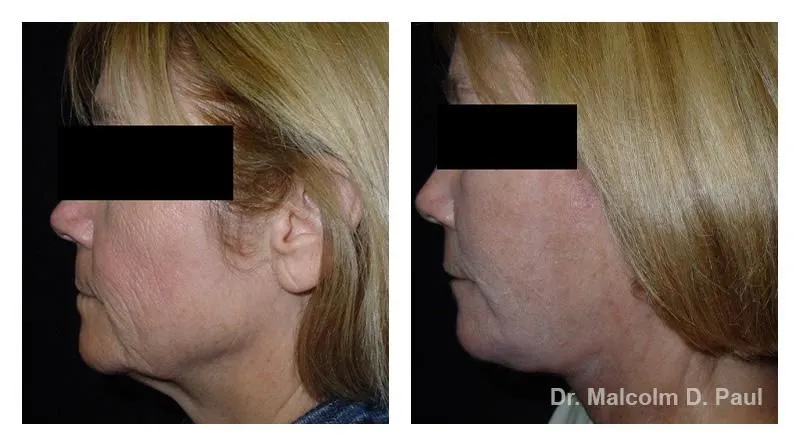 Pre+and+post+op+face+and+necklift8-1920w