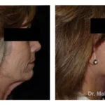 Pre+and+post+op+face+and+necklift9-1920w