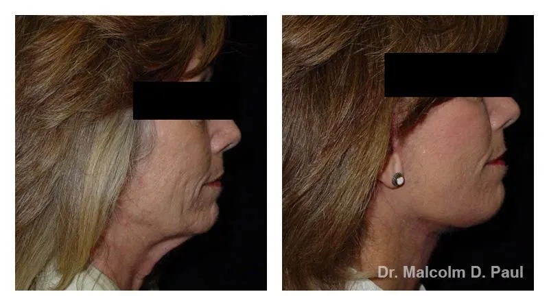 Pre+and+post+op+face+and+necklift9-1920w
