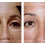 Pre+and+post+op+secondary+lower+lid+blepharoplasties-1920w