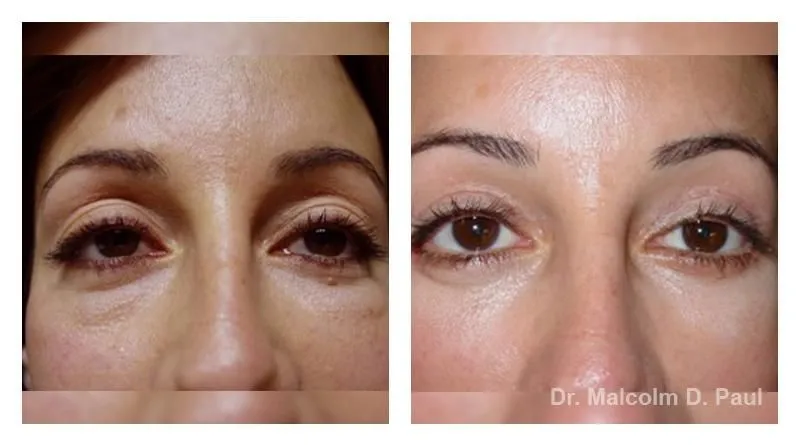 Pre+and+post+op+secondary+lower+lid+blepharoplasties-1920w