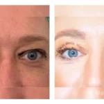 Pre+and+post+op+upper+and+lower+lid+blepharoplasties-1920w