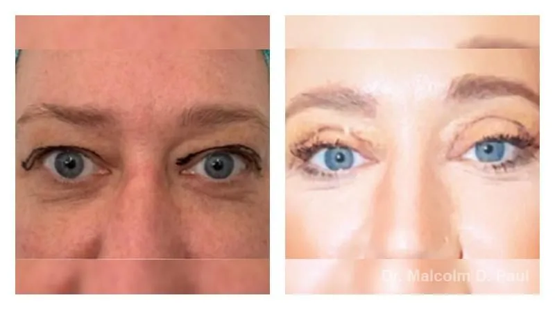 Pre+and+post+op+upper+and+lower+lid+blepharoplasties-1920w