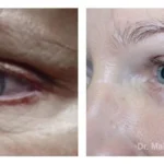 Pre+and+post+op+upper+and+lower+lid+blepharoplasties-+and+browpexy-1920w