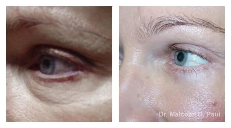 Pre+and+post+op+upper+and+lower+lid+blepharoplasties-+and+browpexy-1920w