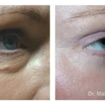 Pre+and+post+op+upper+and+lower+lid+blepharoplasties-+and+browpexy2-1920w