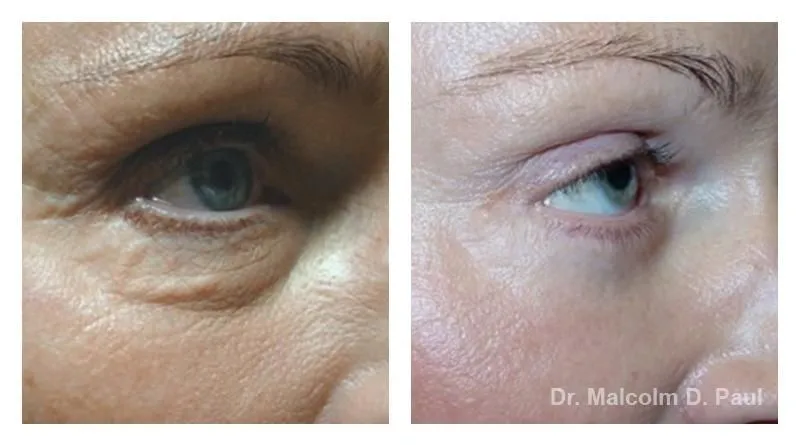 Pre+and+post+op+upper+and+lower+lid+blepharoplasties-+and+browpexy2-1920w