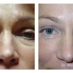 Pre+and+post+op+upper+and+lower+lid+blepharoplasties-+and+browpexy3-1920w